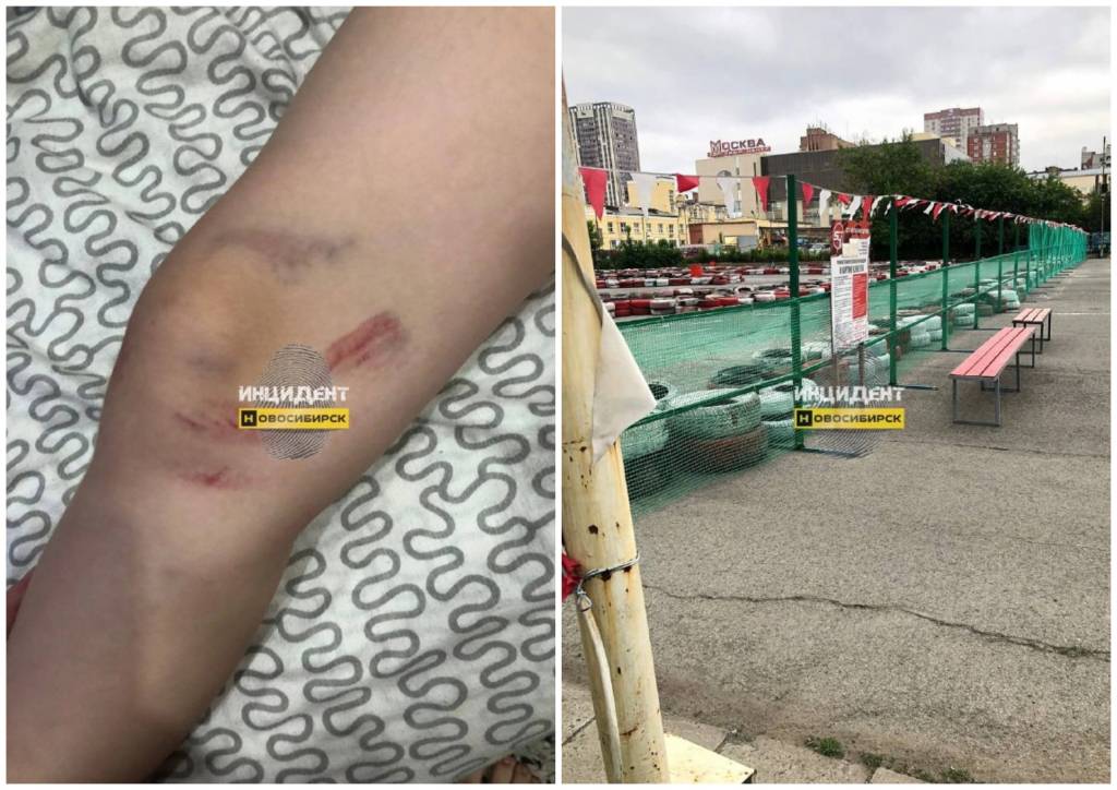 В Новосибирске ребенок получил перелом