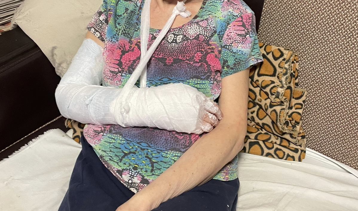 В Новосибирске женщина после инсульта сломала руку в двух местах после падения в троллейбусе