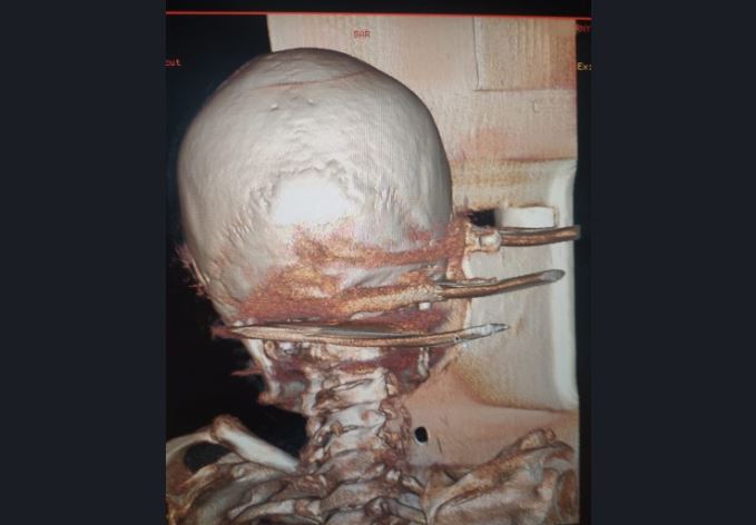 В Новосибирске медики спасли мужчину и вытащили вилы из его головы