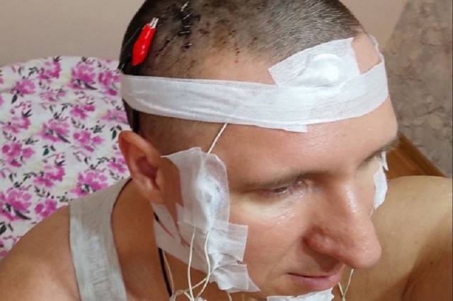 Новосибирец сам вживил себе в мозг имплант с помощью дрели