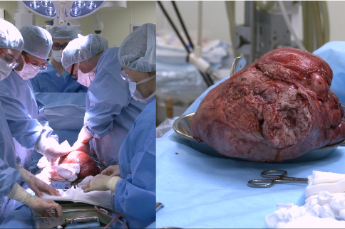 Опухоль размером с голову удалили пациентке в Новосибирске