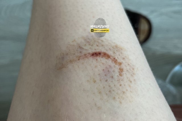 В Новосибирске прокуратура организовала проверку по факту нападения собаки на 16-летнюю девочку