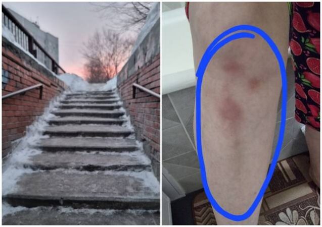 В Новосибирске женщина получила травму на обледенелой лестнице на улице Лесосечной