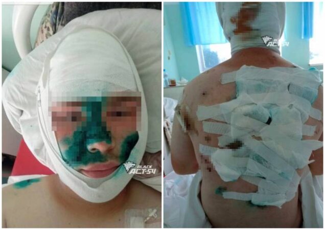 В Новосибирской области зверски избитый сверстниками подросток вышел из комы