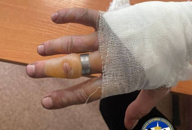 В Новосибирске спасатели помогли освободить палец от кольца мужчине с ожогом на руке