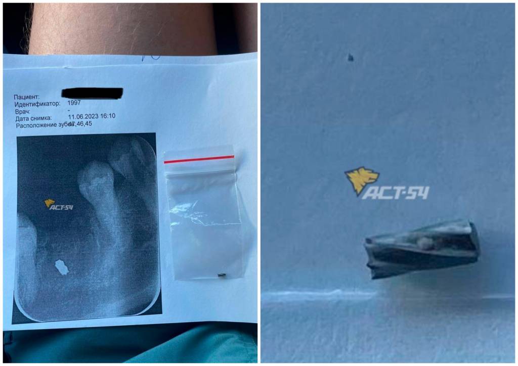 В Новосибирске стоматолог оставил кусок бура в челюсти пациентки