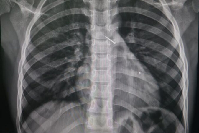 В Новосибирске 9-летний ребенок вдохнул канцелярскую кнопку