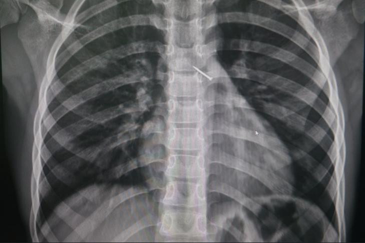 В Новосибирске 9-летний ребенок вдохнул канцелярскую кнопку