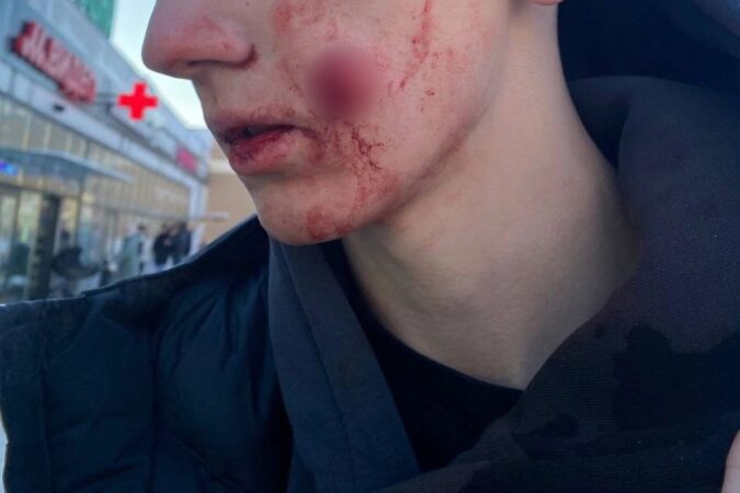 В Новосибирске подростку выстрелили в лицо из сигнального пистолета