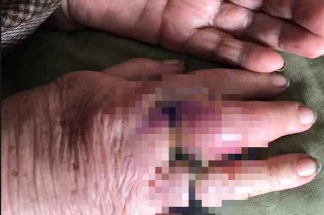 В Новосибирске женщина не смогла снять кольца с отекших пальцев: её увезли к хирургам