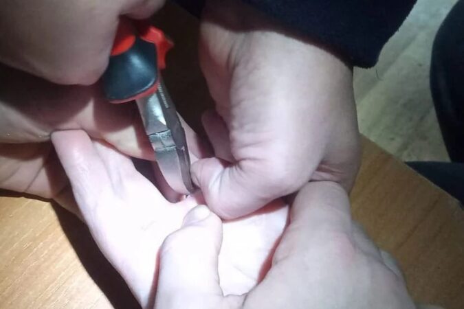 В Новосибирске спасатели сняли кольцо с опухшего пальца женщины