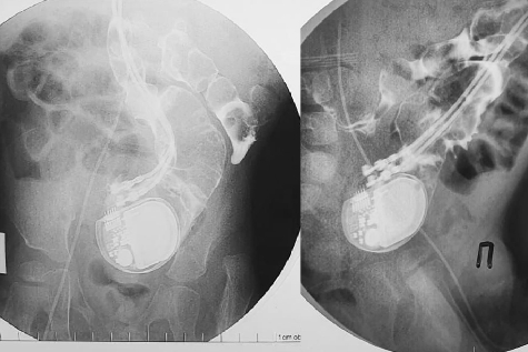 Ребёнка с кардиостимулятором в кишечнике спасли новосибирские хирурги